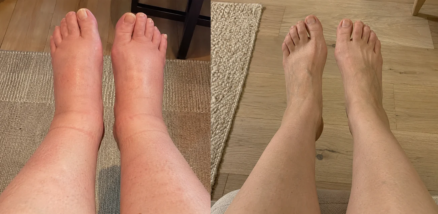 Swollen foot in the summer heat next to a healthy foot